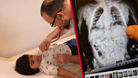 Küçük çocuğun bağırsakları göğüs boşluğuna çıkmış! Gizli hastalığı ortaya çıktı - Sağlık