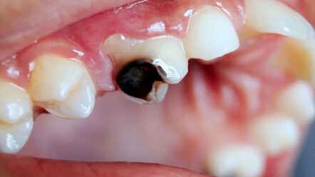 Ağız sağlığında devrim: Çürük dişi onaran jel geliştirildi - Sağlık