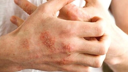 Cilt kuruluğundan egzamaya... Kışın artan deri hastalıklarına dikkat! - Sağlık