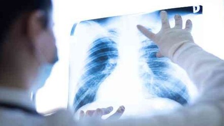 Belirti vermiyor ama ölümcül… Akciğer kanserinde erken tanı önemli - SAĞLIK