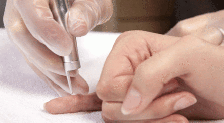 Siğil nasıl geçer? - saglik