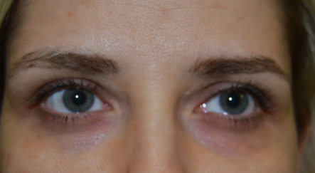 Göz altında morluklar neden olur? | Göz Altı Morlukları Nasıl Geçer? - saglik