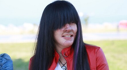 Yüzüne asit döken saldırganı affeden Berfin: Bunu nasıl yapabildim? - gundem