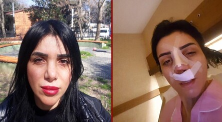 Estetik ameliyatı oldu, psikolojisi bozuldu - yasam
