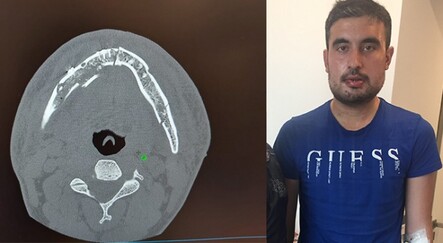 Halat koptu, ucundaki demir kanca işçinin çenesini parçaladı - yasam