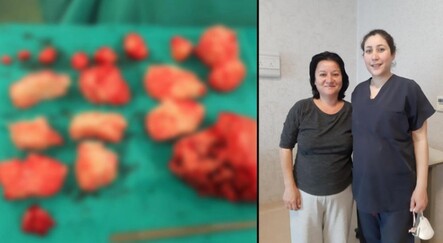 Şişkinlik sandı karnından 1,5 kilo miyom çıktı - saglik