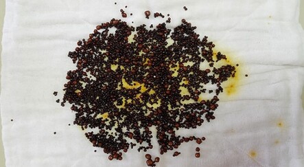 Doktorlar bile şaşırdı! Safra kesesinden 5 binden fazla taş çıktı - saglik