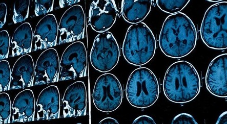 Bilim adamları müjdeyi verdi: ALS hastalığına çare olacak ilaç yolda - saglik