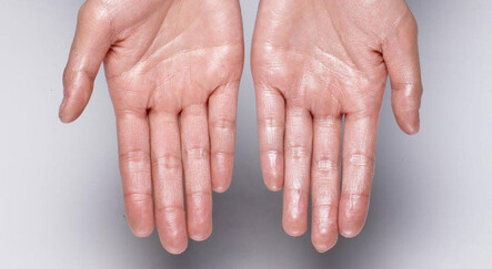 El terlemesi sorunundan 15 dakikada kurtuldu - saglik