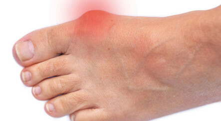 Ayak baş parmak çıkıntısı (halluks valgus) birçok kişide görülüyor: Tedavisi için ne yapmalı, nasıl düzelir? - saglik