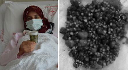 Safra kesesinden 553 tane taş çıkarıldı: Kuş gibi hafiflemiş hissediyorum - saglik
