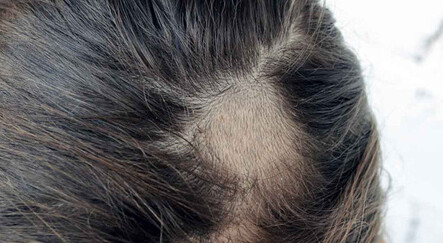 Oscar törenindeki tarihi tokadın ardındaki hastalık:  Alopesi areata - kultur-sanat