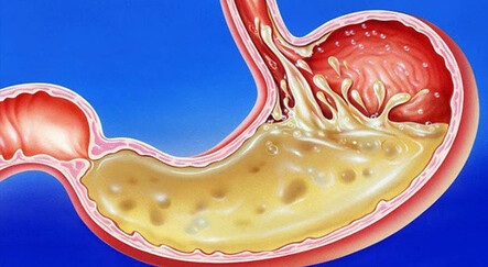 ‘Reflüm var’ diye yemeden içmeden kesilmenize gerek yok! Reflü şikayetlerini azaltan öneriler ile rahat bir nefes alacaksınız - saglik