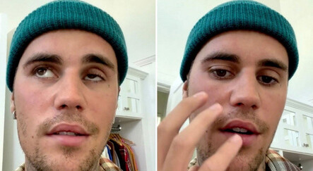 Justin Bieber 'hastalığım kötüye gidiyor' diyerek duyurdu: Yüzümün bir tarafı felçli - magazin