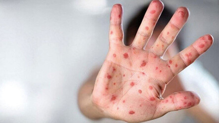 1 saatte teşhis ediyor: Maymun Çiçeği hastalığı için PCR Tanı Kiti geliştirildi - saglik