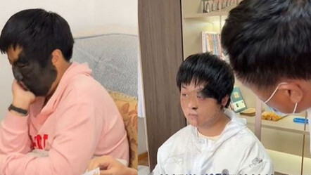 Çinli kıza cilt nakli: Yüzündeki kocaman benden eser kalmadı - saglik