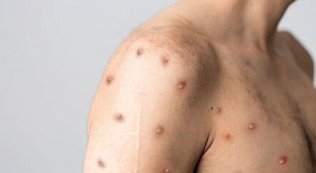 Dünyanın konuştuğu hasta: Covid, HIV ve maymun çiçeği testi pozitif çıktı - saglik
