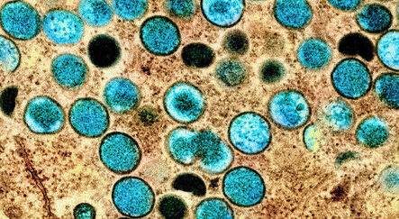 Güneş lekesi sandılar, maymun çiçeği çıktı: Üç günde burnu çürüdü! - saglik