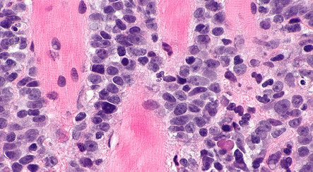 Hiçbir belirti vermeyen HPV yıllar içinde kansere yol açıyor - saglik