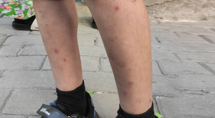 İstanbul'da 'Aedes' istilası: Isırdığı yer yara ve enfeksiyon oluyor - saglik