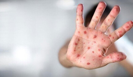 Maymun çiçeğini bir saatte tanıyor - saglik